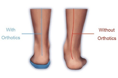 Orthotics