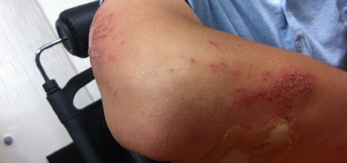 Personal Injury