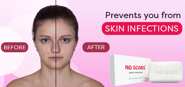 No Scar Face Soap