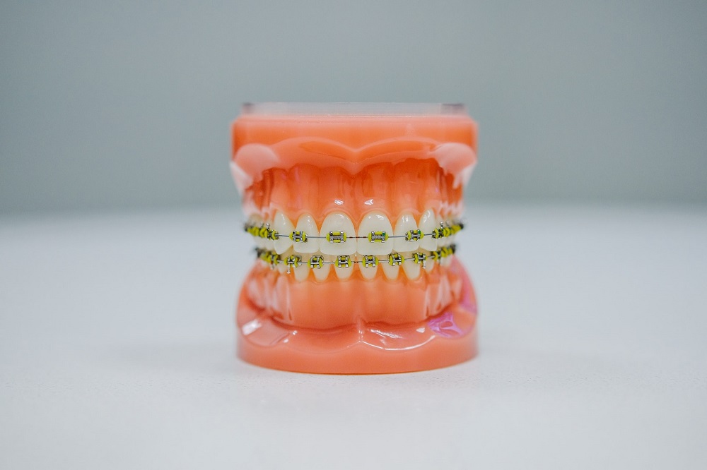 Dental Braces