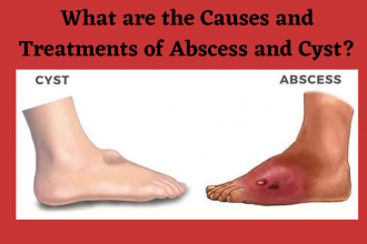 Abscesses and Cysts