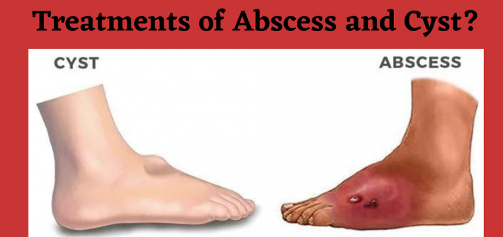 Abscesses and Cysts