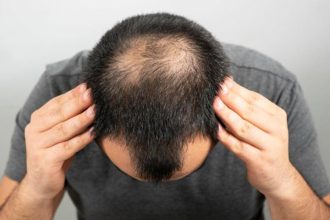 Hair Transplant