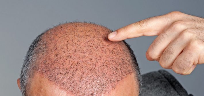 hair transplant