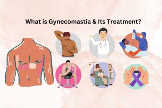 Gynecomastia